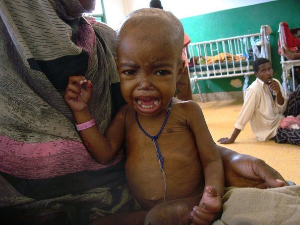 Afrique de l'Ouest et du Centre : Plus de 15 millions de cas de malnutrition aiguë attendus en 2020