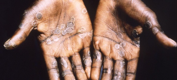 © CDC Des lésions causées par la variole du singe apparaissant sur les paumes des mains.