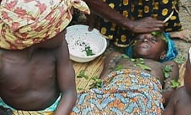 SANTE : Près de 200 millions de femmes victimes de mutilations génitales