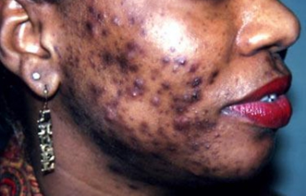 TRANSFORMATIONS CORPORELLES  AFRICAINES :   Le CODESRIA met en garde contre les dangers du « khessal »
