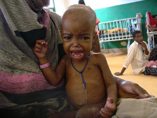 Un enfant somalien souffrant de malnutrition aigue Un enfant somalien souffrant de malnutrition aigue
