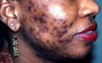 TRANSFORMATIONS CORPORELLES  AFRICAINES :   Le CODESRIA met en garde contre les dangers du « khessal »