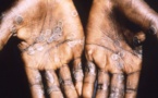 L’OMS signale 1.400 cas de variole du singe en Afrique